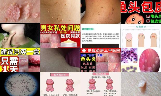 汕头龟头炎症刺激感染导致小肉粒