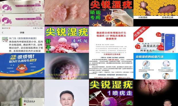汕头那里治疗尖锐湿疣*好