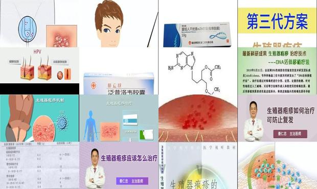 汕头那里治疗生殖器疱疹