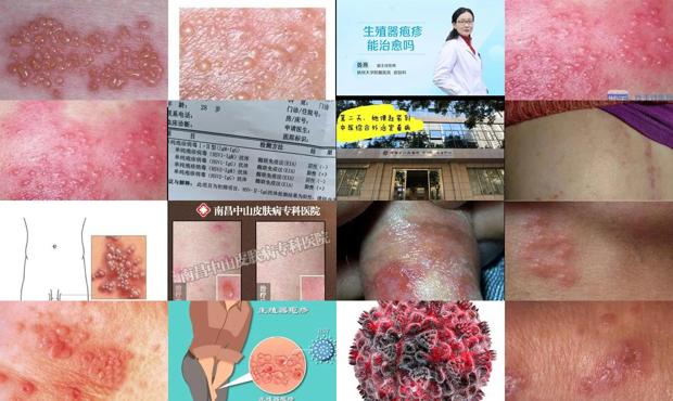 汕头哪个医院可以看生殖疱疹