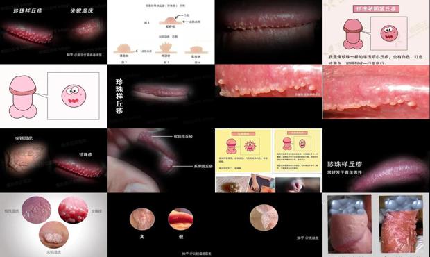 汕头珍珠疹和尖锐湿区分图