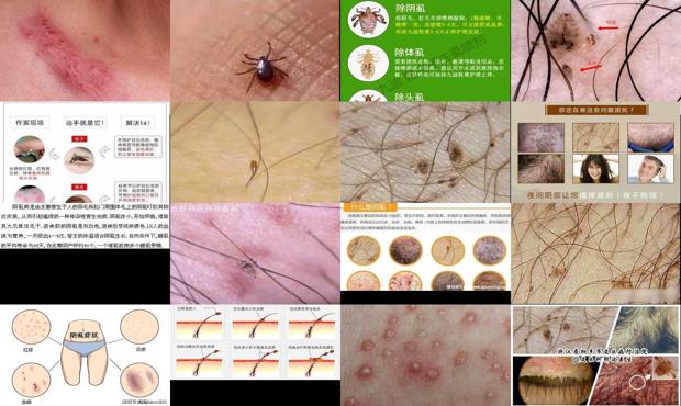汕头阴虱汕头阴虱是什么原因得的