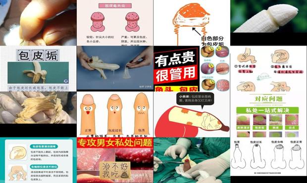 汕头包皮垢