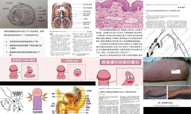 汕头龟头淋巴管炎症状
