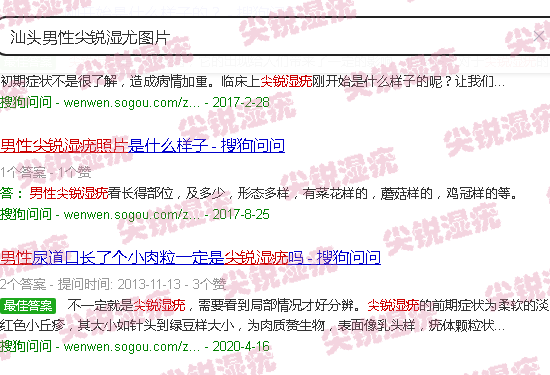 汕头男性尖锐湿尤图片