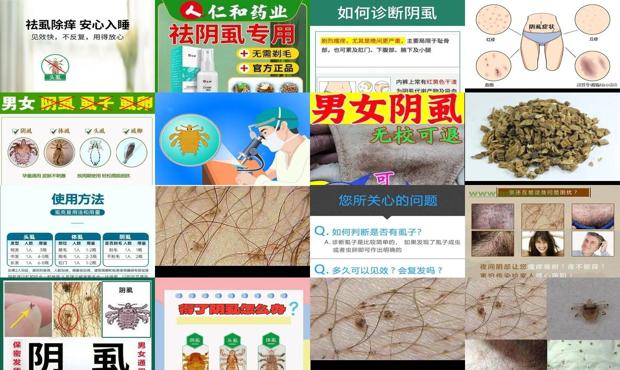 汕头阴虱*好的治疗方法
