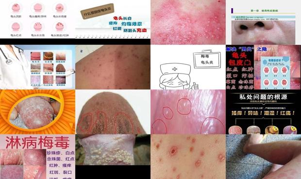 汕头龟头炎和梅毒区别照片