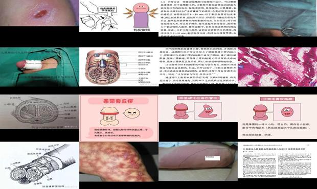汕头阴茎硬性淋巴管炎症状图片
