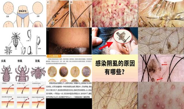 汕头阴虱是怎么引起的