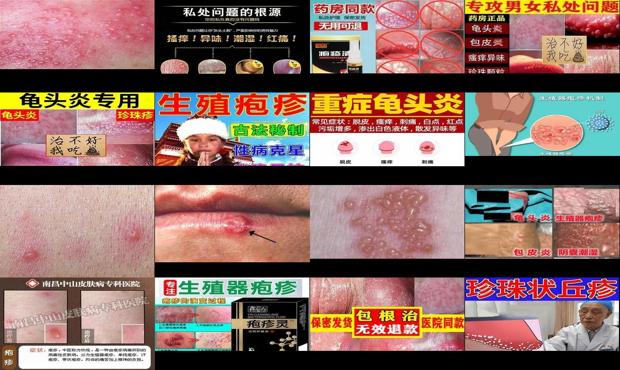 汕头龟头疱疹