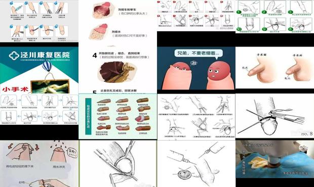 汕头怎么割包皮