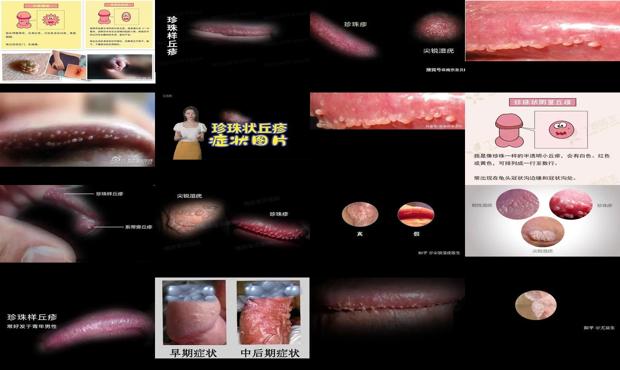 汕头珍珠疹和尖锐湿疣区别图