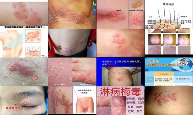 汕头生殖疱疹和带状疱疹的区别