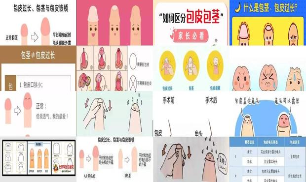 汕头怎么判断包皮