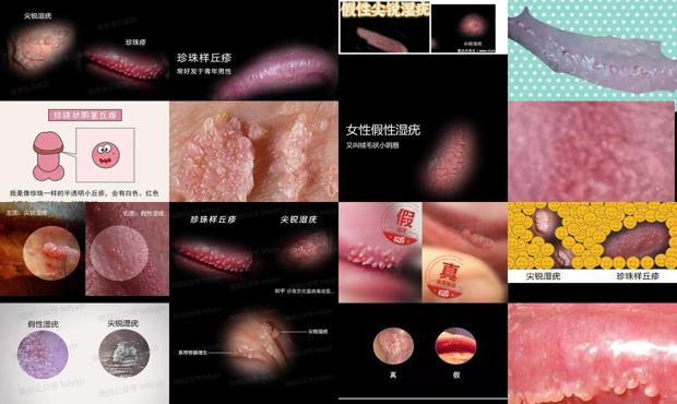 汕头假性尖锐和真性区别图