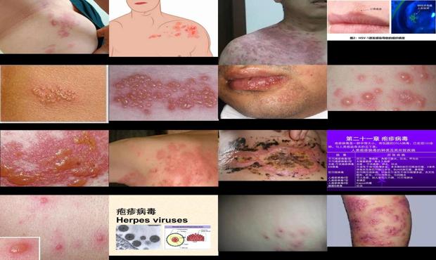 汕头疱疹*是什么引起的