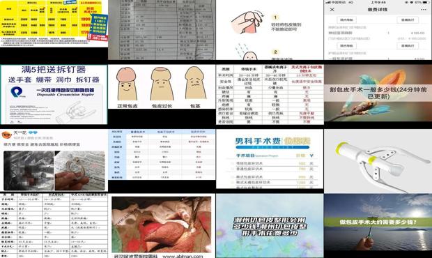 汕头包皮切割多少钱