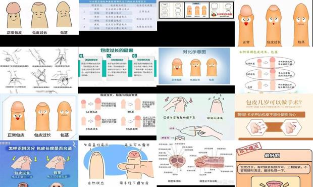 汕头包皮如何算过长