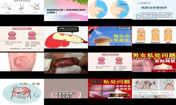 汕头包皮红肿发痒怎么办