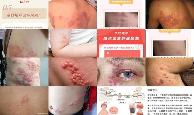 汕头带状疱疹传染吗