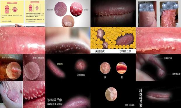 汕头珍珠疹和尖锐的区别图