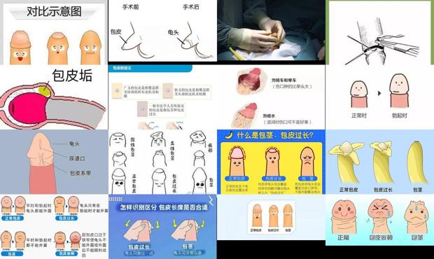 汕头包皮是怎样的