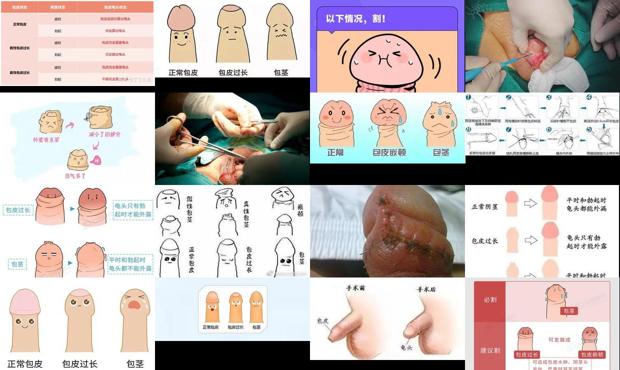 汕头男人包皮是什么样子