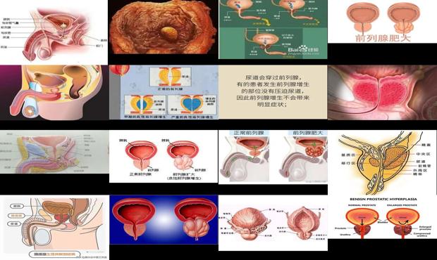 汕头什么是前列腺肥大图片