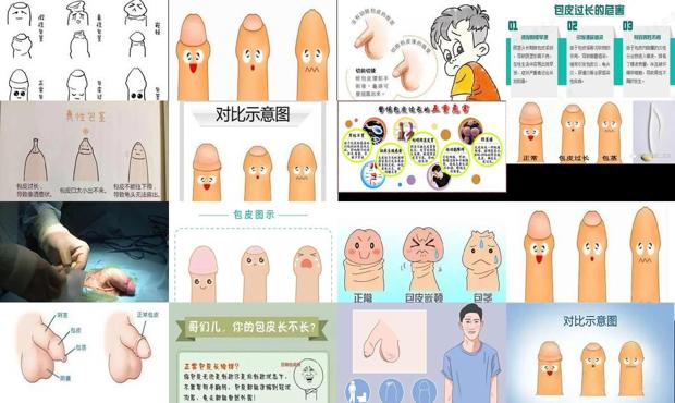汕头包皮过长的症状
