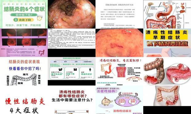 汕头结肠炎症状