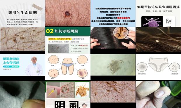 汕头阴虱卵掉床上会存活吗