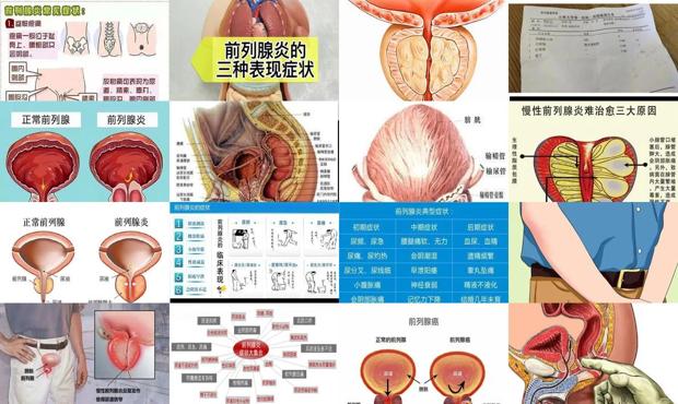 汕头早期前列腺炎症状