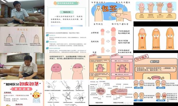 汕头包皮怎样算过长