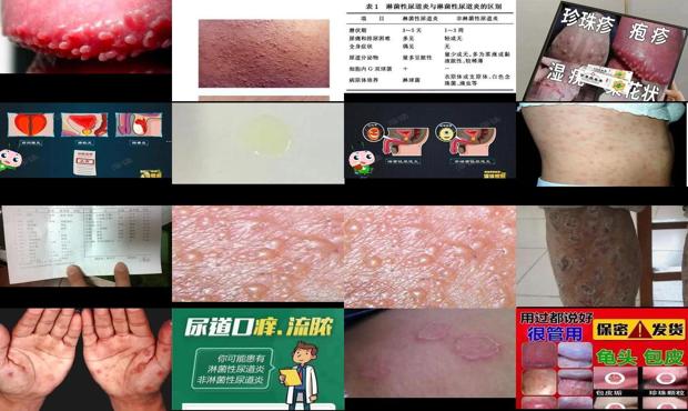 汕头单纯性淋球菌性尿道炎症状