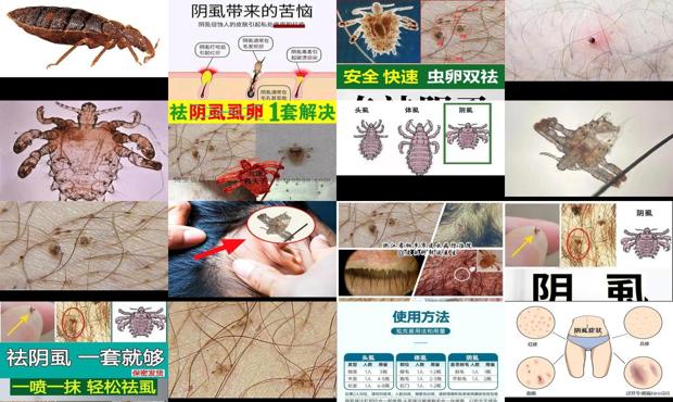 汕头阴虱*怕什么