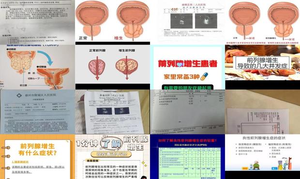 汕头前列腺增生*坏的结果