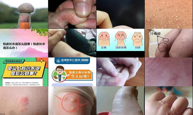 汕头包皮上长水泡是怎么回事