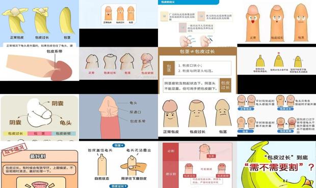 汕头包皮是什么