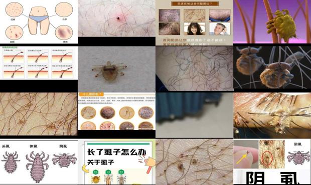 汕头阴虱怎么来的