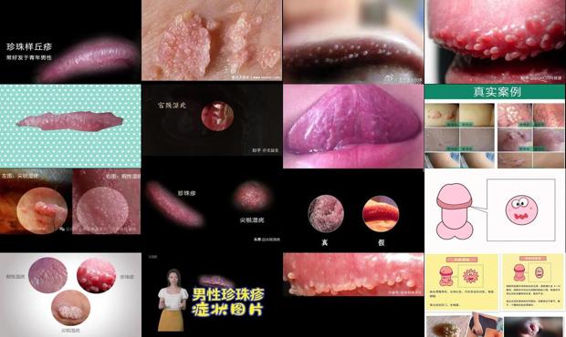 汕头尖锐湿疣和珍珠疹图片对比