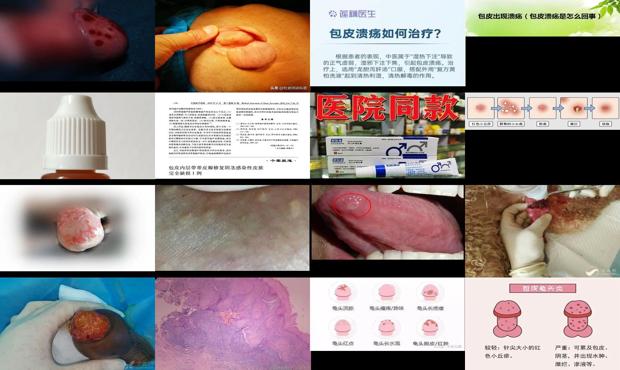 汕头包皮溃烂