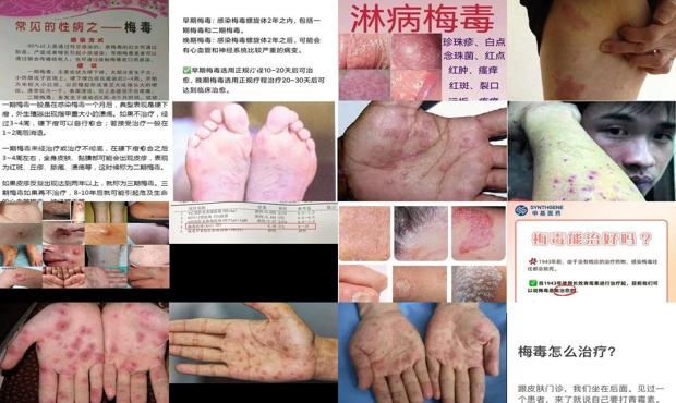 汕头梅毒能治好吗