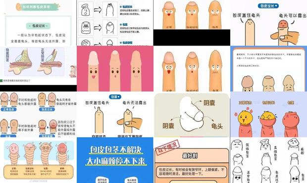 汕头男孩子包皮