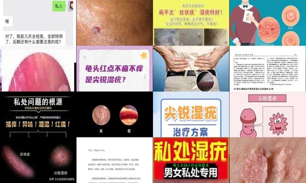 汕头龟头尖锐湿疣怎么治疗