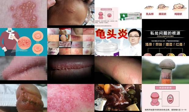 汕头包皮上有小疱疹图片