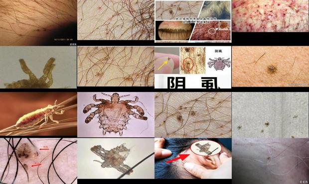 汕头阴虱是什么