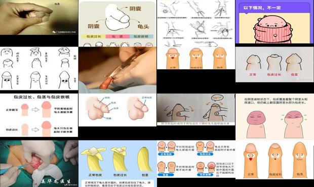 汕头鸡鸡包皮过长