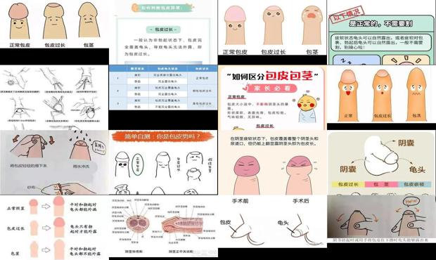汕头男人如何判断包皮过长