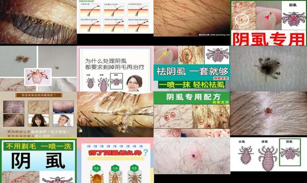 汕头阴虱虫子怎么治疗*快