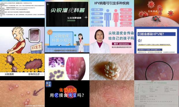 汕头尖锐湿疣怎么传染